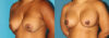 Revision Breast Surgery case #7878 slider thumbnail
