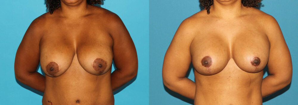 Revision Breast Surgery case #7878