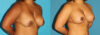 Revision Breast Surgery case #7878 slider thumbnail