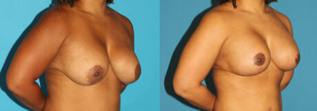 Revision Breast Surgery case #7878
