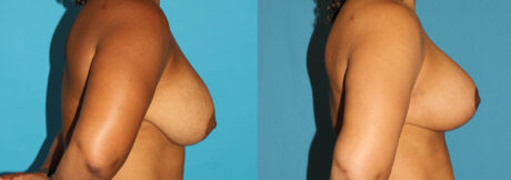 Revision Breast Surgery case #7878