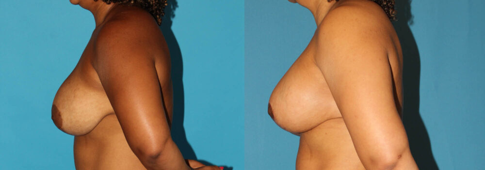 Revision Breast Surgery case #7878