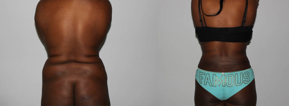 Tummy Tuck case #7094