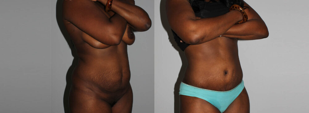 Tummy Tuck case #7094