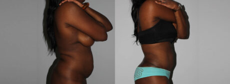 Tummy Tuck case #7094
