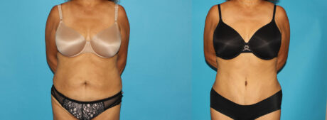 Tummy Tuck case #7233