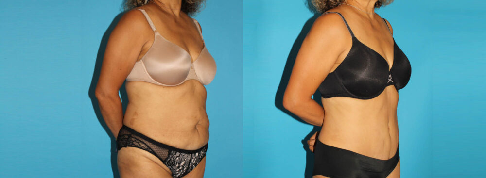 Tummy Tuck case #7233