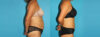 Tummy Tuck case #7233 slider thumbnail