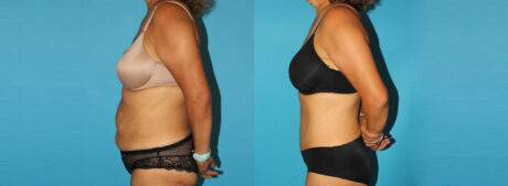 Tummy Tuck case #7233