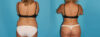 Tummy Tuck case #7280 slider thumbnail