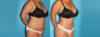 Tummy Tuck case #7280 slider thumbnail