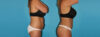 Tummy Tuck case #7280 slider thumbnail