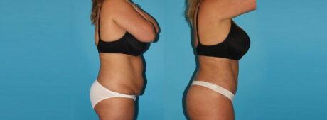 Tummy Tuck case #7280