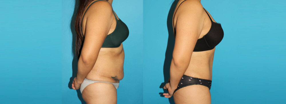 Tummy Tuck case #7281