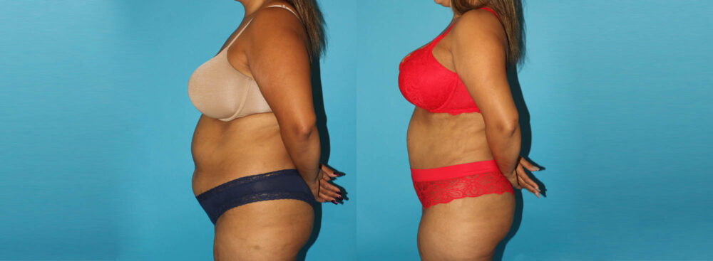 Tummy Tuck case #7234