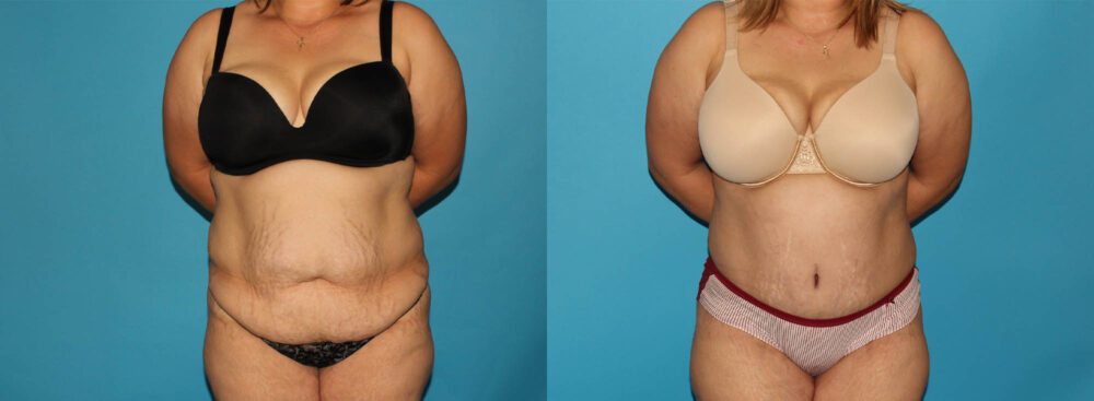 Tummy Tuck case #7167