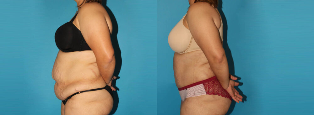 Tummy Tuck case #7167