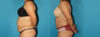 Tummy Tuck case #7167 slider thumbnail