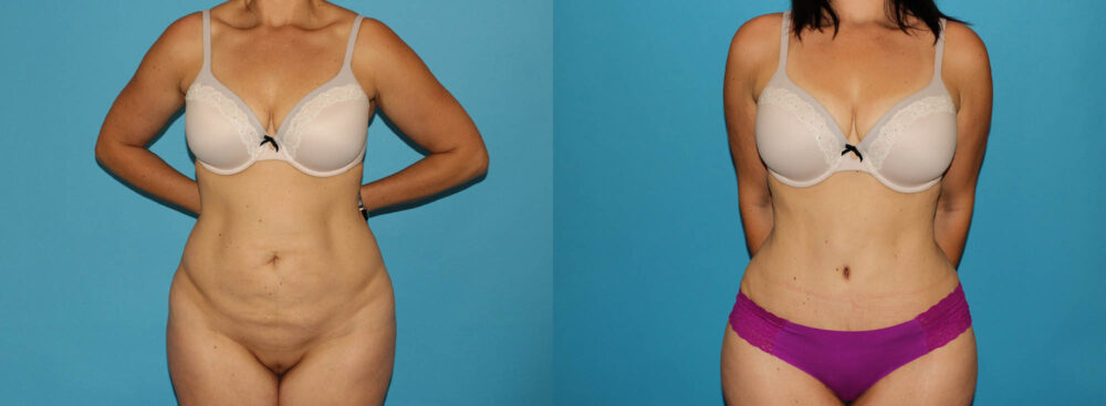 Tummy Tuck case #7169