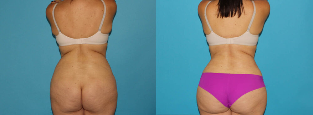 Tummy Tuck case #7169