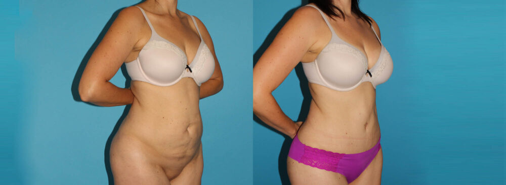 Tummy Tuck case #7169