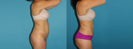 Tummy Tuck case #7169