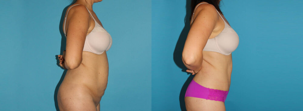 Tummy Tuck case #7169