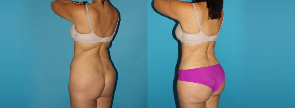 Tummy Tuck case #7169