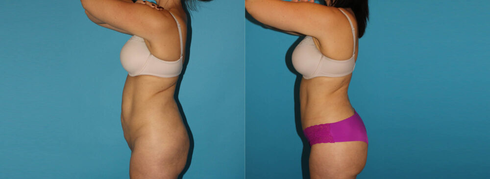 Tummy Tuck case #7169