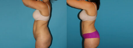 Tummy Tuck case #7169