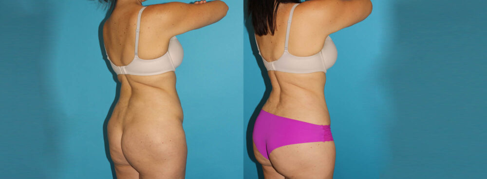 Tummy Tuck case #7169