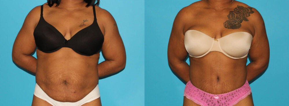 Tummy Tuck case #7283