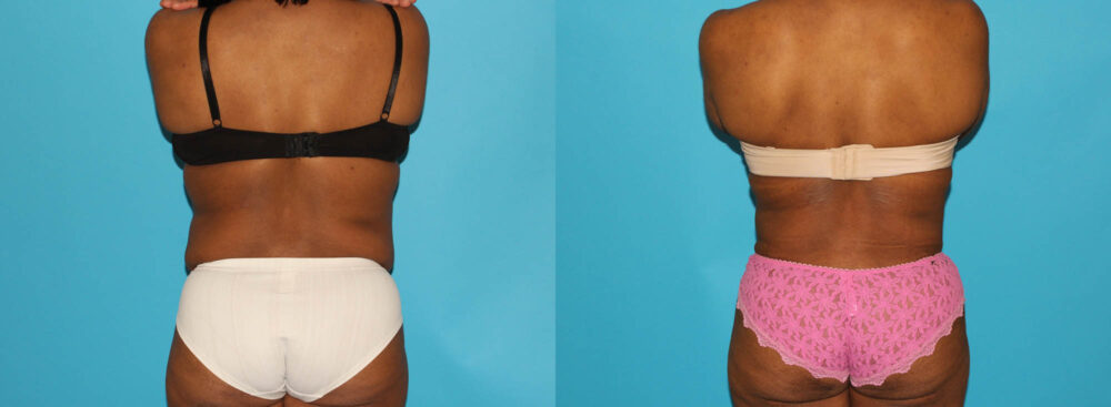 Tummy Tuck case #7283