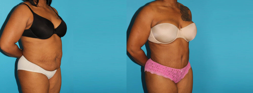 Tummy Tuck case #7283