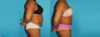 Tummy Tuck case #7283 slider thumbnail