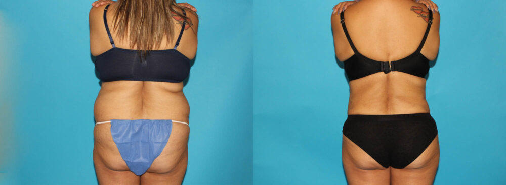 Tummy Tuck case #7170