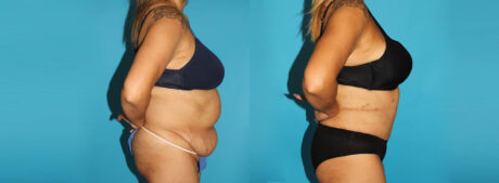 Tummy Tuck case #7170