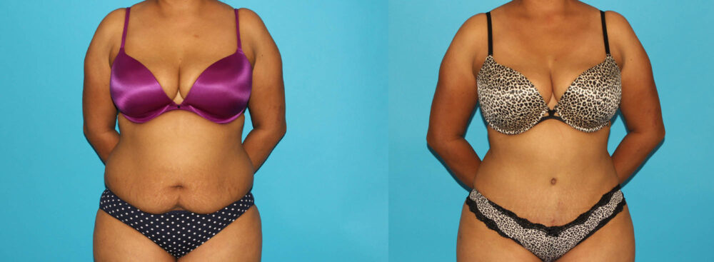 Tummy Tuck case #7279