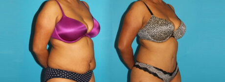 Tummy Tuck case #7279