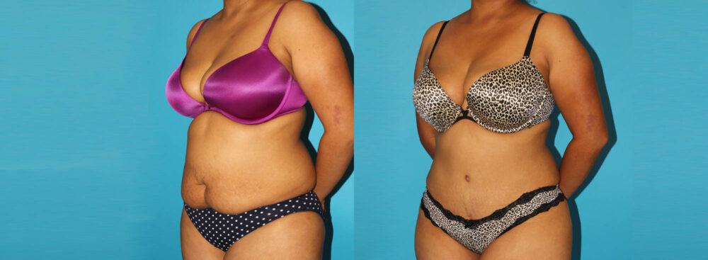 Tummy Tuck case #7279