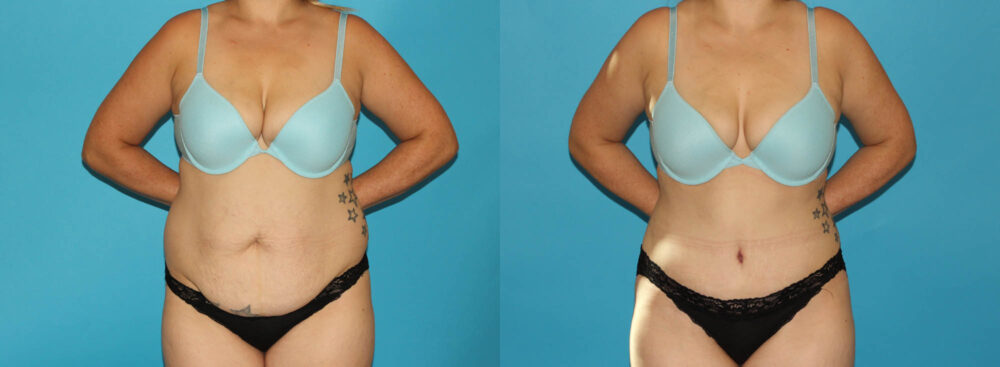 Tummy Tuck case #7278