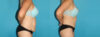 Tummy Tuck case #7278 slider thumbnail