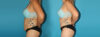 Tummy Tuck case #7278 slider thumbnail