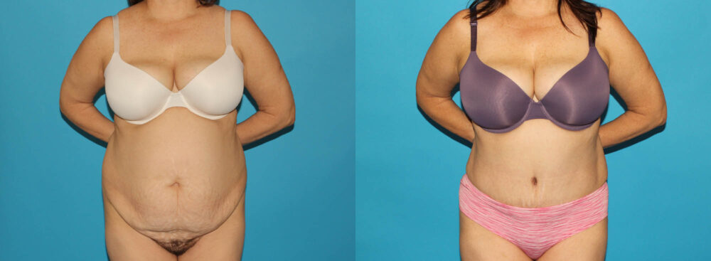 Tummy Tuck case #7171