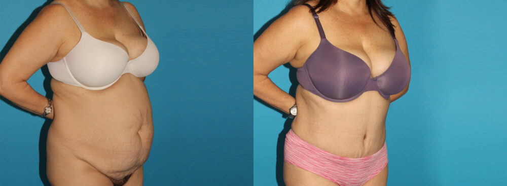 Tummy Tuck case #7171