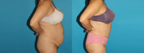 Tummy Tuck case #7171
