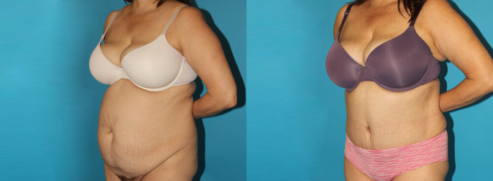 Tummy Tuck case #7171