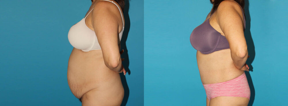 Tummy Tuck case #7171