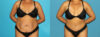 Tummy Tuck case #7276 slider thumbnail