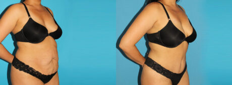 Tummy Tuck case #7276